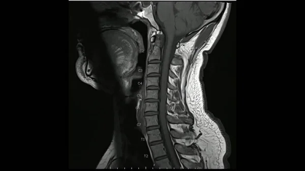 Mágneses Rezonancia Képek Nyaki Gerinc Sagittal Súlyozott Képekről Mri Nyaki — Stock Fotó