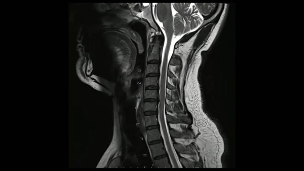 Magnetic Resonance images of Cervical spine sagittal T2-weighted images (MRI Cervical spine) showing Multiple disc disease, more evident at C5-6 disc.