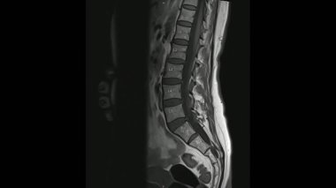 Lumbar sagittal T1 ağırlıklı görüntülerin (MRI Lumbar omurga) hafif disk hastalığını gösteren manyetik rezonans görüntüleri.