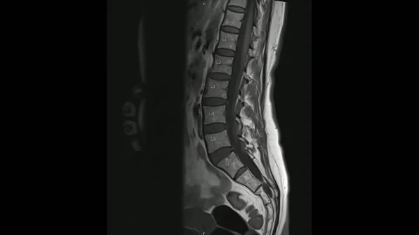 Magnetic Resonance images of Lumbar spine sagittal T1-weighted images  (MRI Lumbar spine) showing mild disc disease.