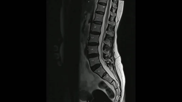Magnetic Resonance images of Lumbar spine sagittal T2-weighted images  (MRI Lumbar spine) showing mild disc disease.