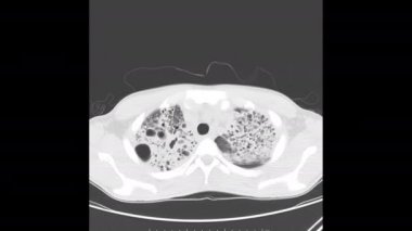 Aktif akciğer tüberkülozu (TB) olan bilinen bir hastada göğüs tomografisi (akciğer penceresi) her iki akciğerde de pnömoni ve kavitasyon olduğunu gösteriyor.