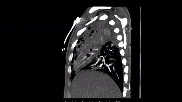 Počítačová Tomografie Plicní Arterie Agitální Rovině Pro Diagnózu Plicní Embolie — Stock video