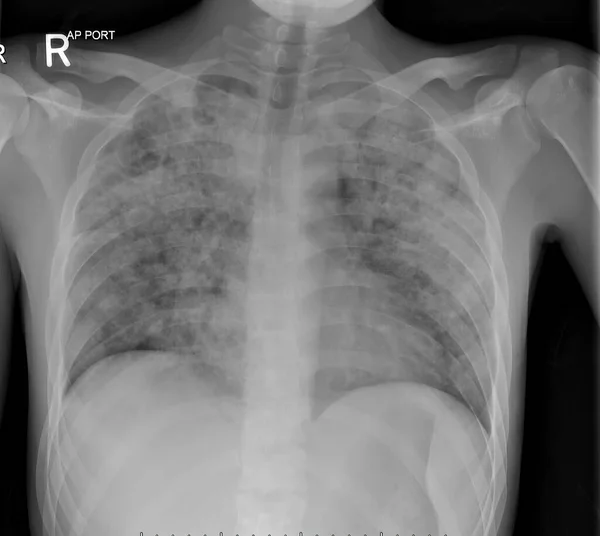 Radiographie Poitrine Chez Patient Atteint Tuberculose Pulmonaire Active Montrant Une — Photo