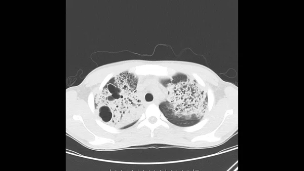 Mellkas Tüdőablak Axiális Komputertomográfiája Aktív Tuberkulózisban Tbc Szenvedő Mindkét Tüdőben — Stock Fotó