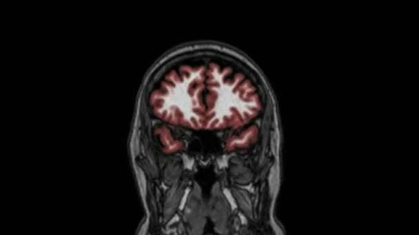 Imágenes Por Resonancia Magnética Del Cerebro Secuencia Codificada Por Color — Vídeo de stock