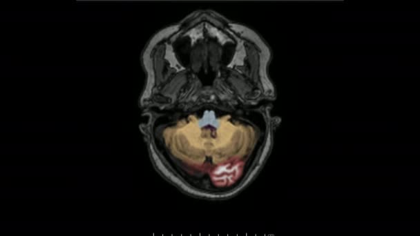 Rezonans Magnetyczny Mózgu Osiowej Płaskiej Sekwencji Kodowanej Kolorami Stosowanej Diagnozowania — Wideo stockowe