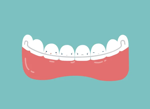 Dientes Retenedores Concepto Dental — Vector de stock