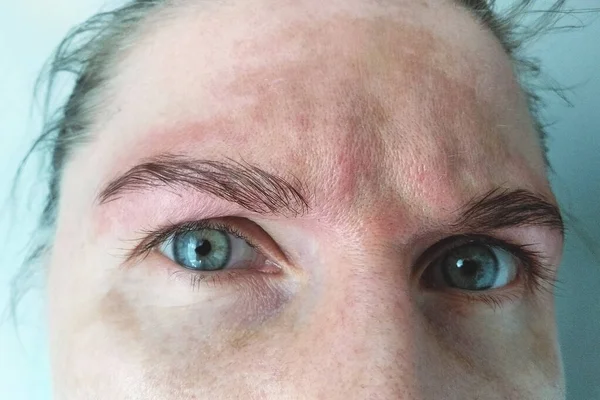 Mancha Melasma Pigmentación Tratamiento Facial Cara Mujer Problema Cuidado Piel — Foto de Stock