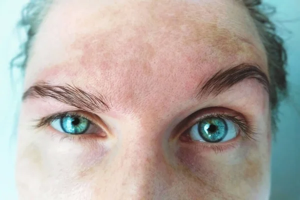 Spot Melasma Pigmentering Ansiktsbehandling Ansikte Kvinna Problemhud Och Hälsobegrepp Royaltyfria Stockfoton