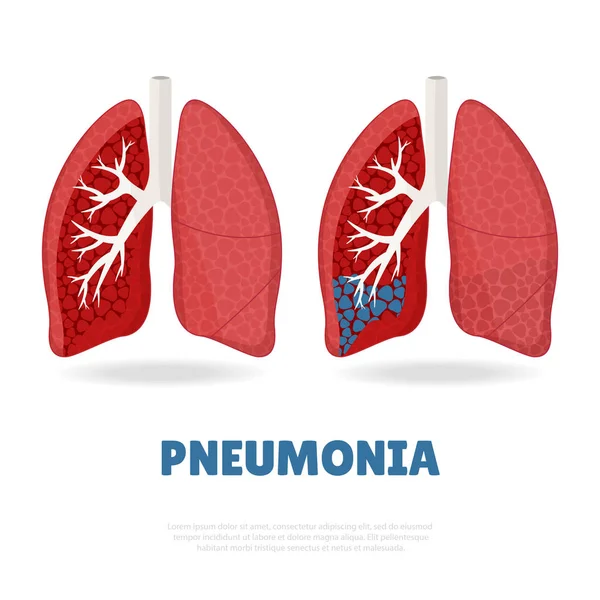 Pneumonia — Vetor de Stock
