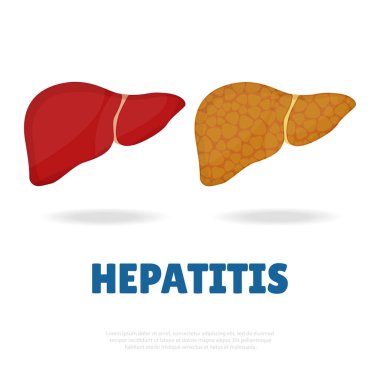 Hepatit konulu vektör illüstrasyonu. Sağlıklı ve hasta karaciğer.
