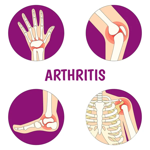 Illustration Vectorielle Sur Thème Journée Mondiale Arthrite — Image vectorielle