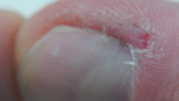 Inflamación de la piel del dedo cerca de la uña . — Vídeo de stock