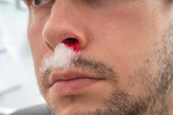 Mladý Muž Krvácení Nosu Vaty Nosní Dírky — Stock fotografie
