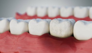 Enfekte diş ağızda. 3D render illüstrasyon.