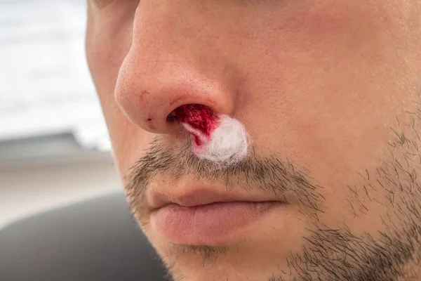 出血の鼻を持つ男は 鼻孔の血まみれのコットン ウール — ストック写真