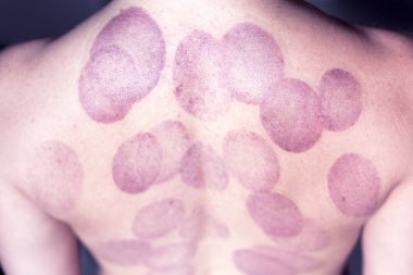 Kadın arka yakın çekim terapötik vakum masajı izleri