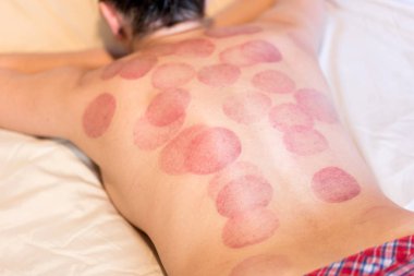 Tıbbi masaj lar. Bir kadından masaj izleri.