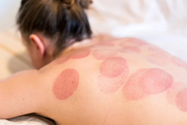 Vrouw met sporen van vacuüm massage op de rug close-up — Stockfoto