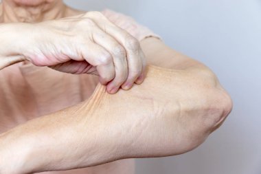Yaşlı yaşlı bir kadın kolunda derisini kötü bir turgor ile yüzüyor ve derisini soyuyor.