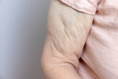Aşırı kilo verdikten sonra yaşlı bir kadının kolunda çok fazla deri var.