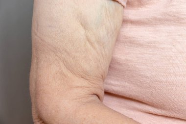 Aşırı kilo verdikten sonra yaşlı bir kadının kolunda çok fazla deri var.