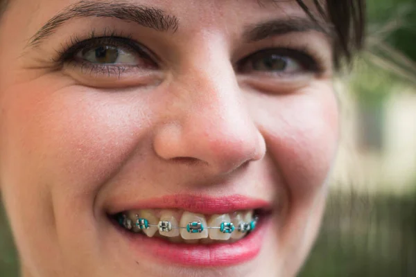 Close up photo of women with braces smiling at camera
