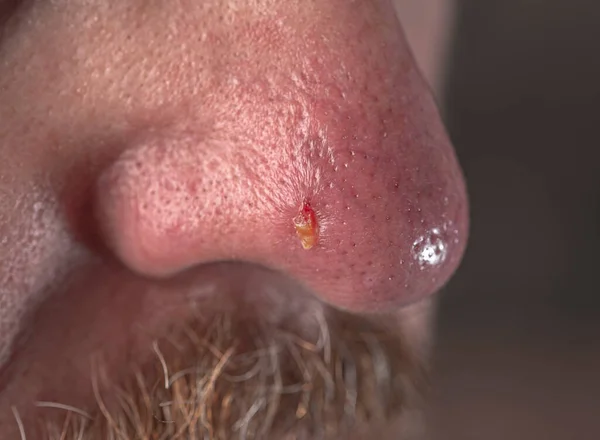 Rosacea ve egzama ile cilt yüzeyi.