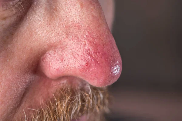 Rosacea ve egzama ile cilt yüzeyi.