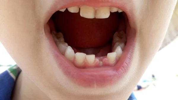 第一颗乳牙掉了出来 牙齿在小孩的嘴里 — 图库照片