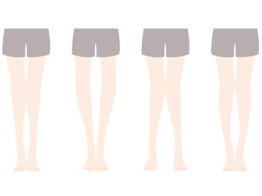 Comparison illustration of distortion of O-leg and X-leg clipart