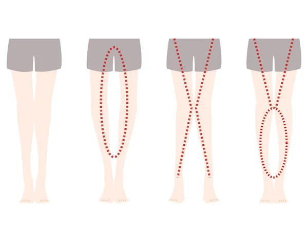 O腿和X腿畸变的对比分析 — 图库矢量图片
