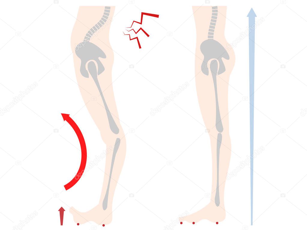 Illustration of lower body and bone distortion of floating fingers