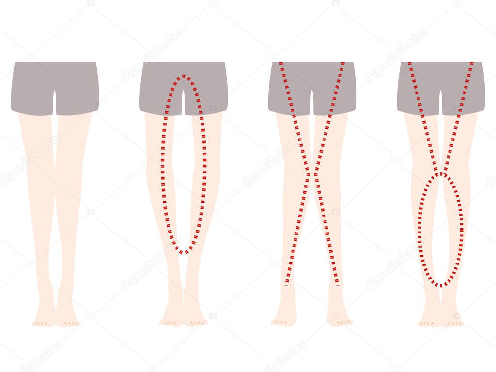 Comparison illustration of distortion of O-leg and X-leg