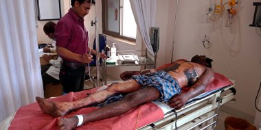 DİSTRİK KATNI, Hindistan - 28 Eylül 2019: Hintli bir erkek doktor şehir devlet hastanesinde yanan hastayı kontrol ediyor.