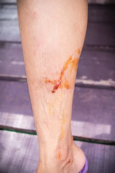 Fresh wounds caused by accidents have to heal wounds. Accident on the leg is bleeding.