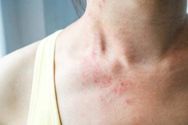 Roseola Stock Photos Royalty Free Roseola Images Depositphotos
