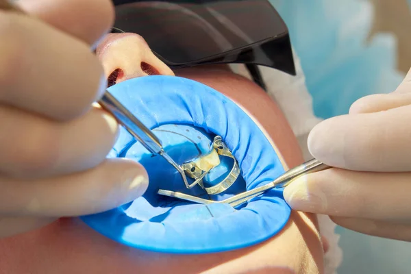 Patiënt krijgen tandheelkundige behandeling op tandartspraktijk met tandheelkundige rubber dam bescherming — Stockfoto
