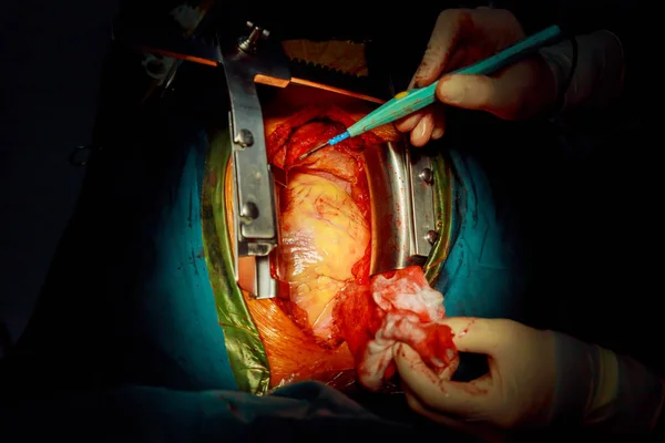 Ile Koroner Arter Hastalığında Cerrahi Ameliyathane — Stok fotoğraf