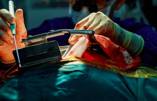 Maldita Operación Quirúrgica Herida Del Tórax Cirugía Cardíaca — Foto de Stock