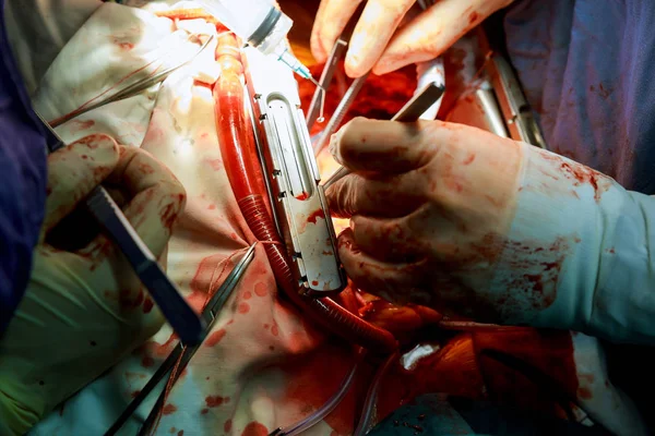 Chirurg Kneift Den Schlauch Und Blockiert Die Durchblutung Während Der — Stockfoto