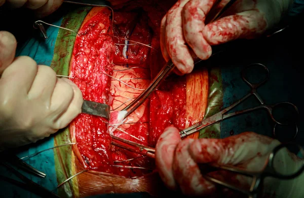 Chirurgen Hände Stichen der Gewebe des Kopfes nach Trepanning — Stockfoto