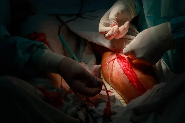 Doktorlar Ameliyat Odasında Damar Cerrahisi Prosedürü Sırasında Damar Cerrahisi Prosedürü — Stok fotoğraf
