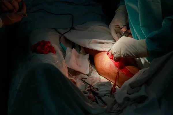 Visszerek Érsebészet Seb Lábát Sebészeti Eszközök Működése Során — Stock Fotó