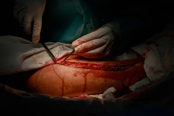 Primer Plano Del Médico Cirujano Cosiendo Pie Paciente Después Cirugía — Foto de Stock