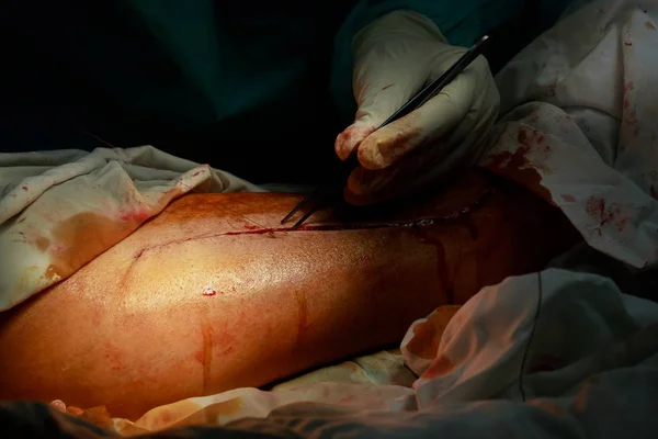 Kirurger Suturering Lång Sjuka Patienten Efter Allvarlig Operation Närbild Kirurgen — Stockfoto