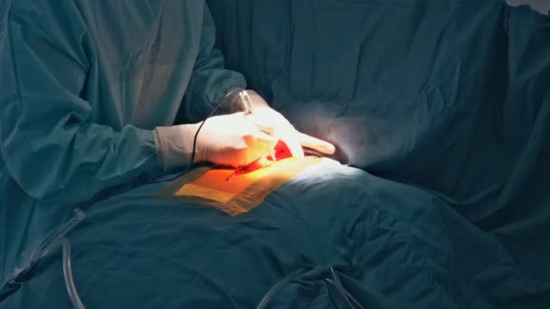 Disposable electrosurgical pencil. Cutting the chest during an operation on the heart — Stock Video