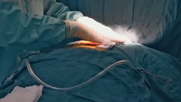 Corte do tórax durante uma operação no coração, abertura cirúrgica da mama durante a operação cirúrgica . — Vídeo de Stock