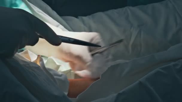 Kirurger suturering en lång på sjuka patienten efter en allvarlig operation. — Stockvideo